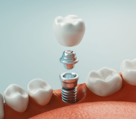 Dental Implants Cost in Hyderabad – Complete Guide