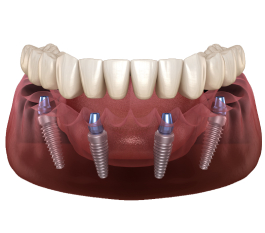 Full Mouth Dental Implants Cost in Hyderabad