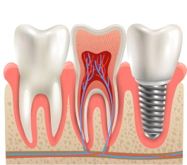 Painless Root Canal Treatment in Hyderabad, India